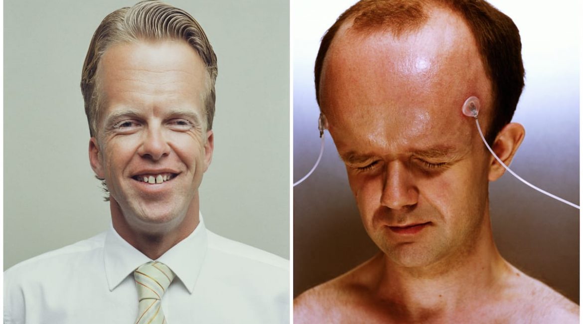 Who has the biggest forehead in the world?