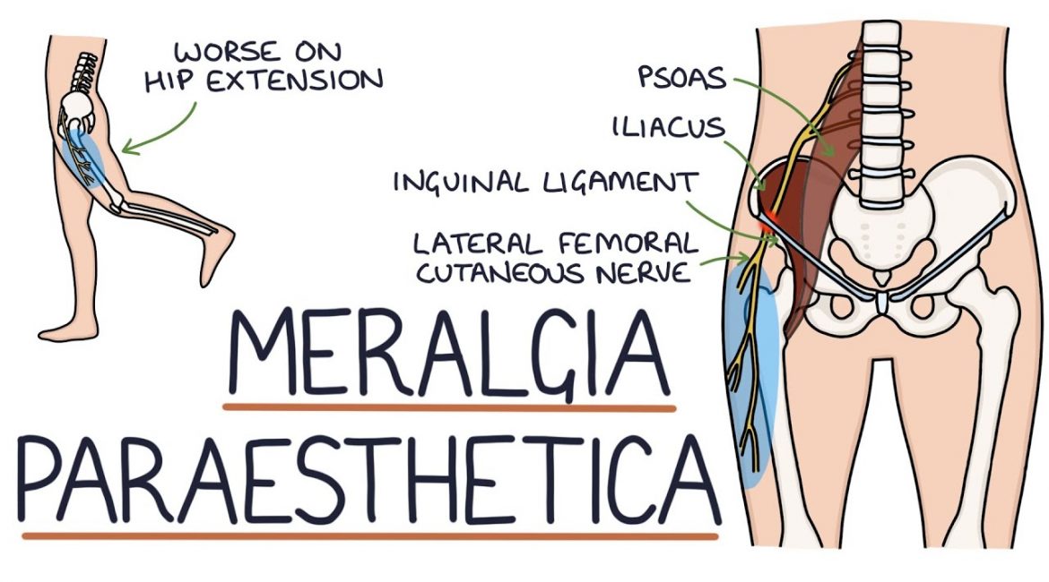 How to Sleep With Meralgia Paresthetica?